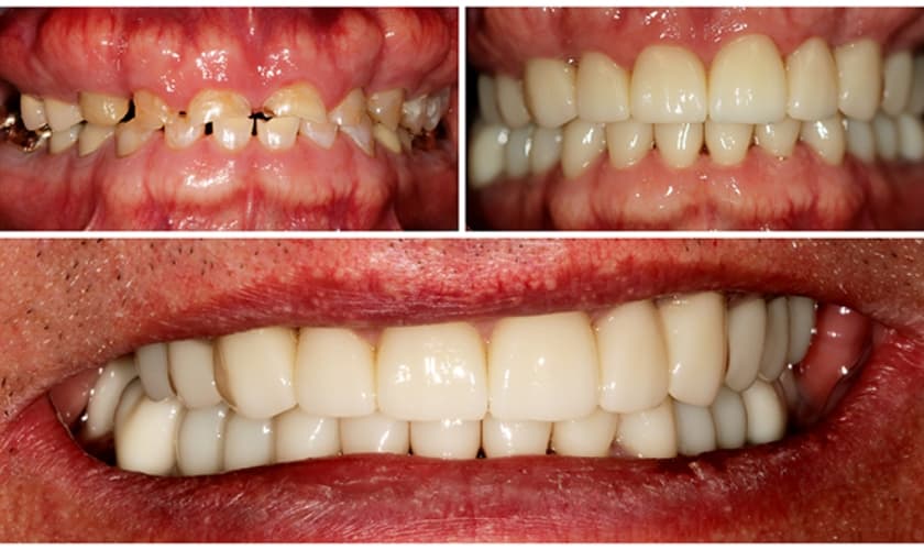 Dental Rehabilitation at Clear Dental Care, Perambalur