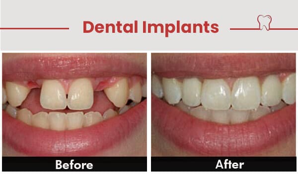 Multiple teeth rehabilitation — Dental Rehabilitation at Clear Dental Care, Perambalur