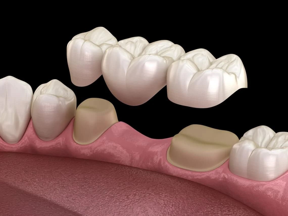 Crowns & Bridges at Clear Dental Care, Perambalur